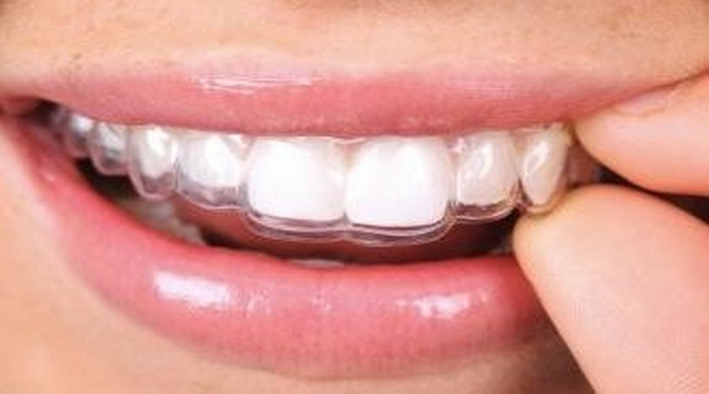 HAPPY BRACES