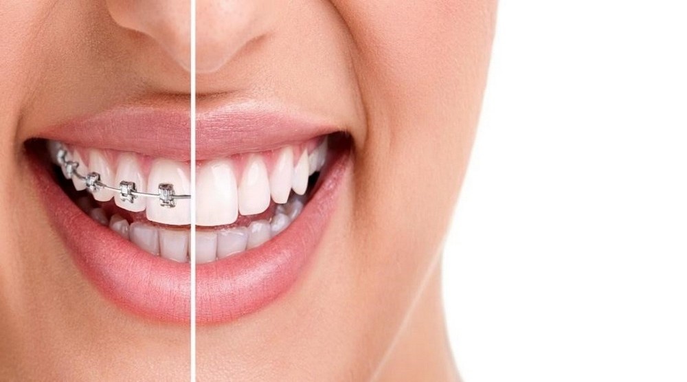 HAPPY BRACES