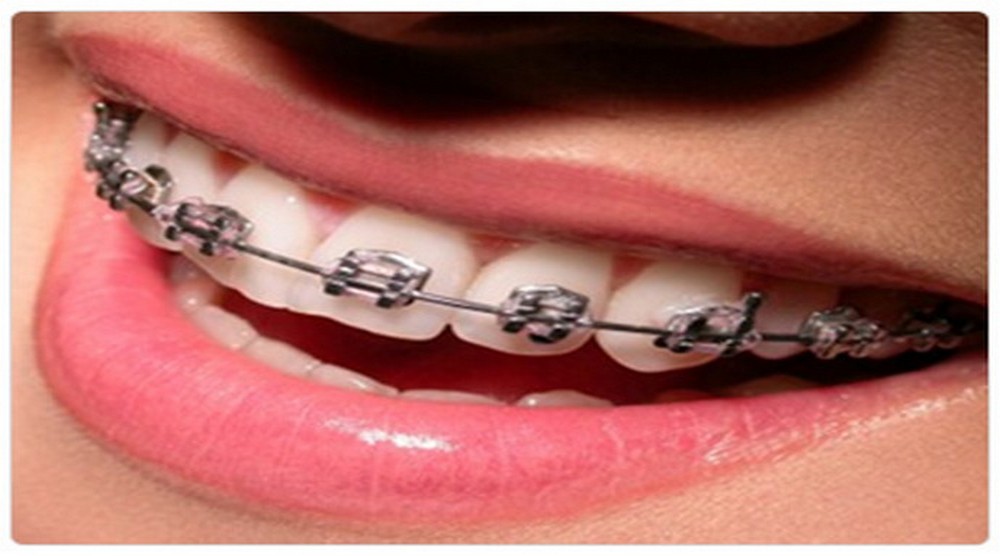 HAPPY BRACES