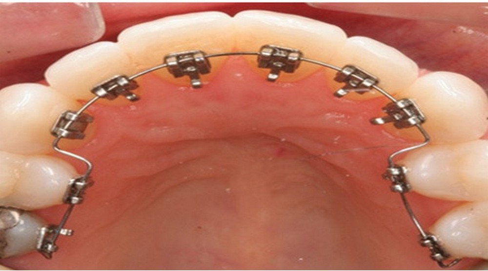 HAPPY BRACES