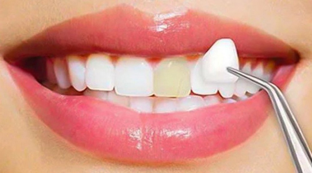 HAPPY BRACES