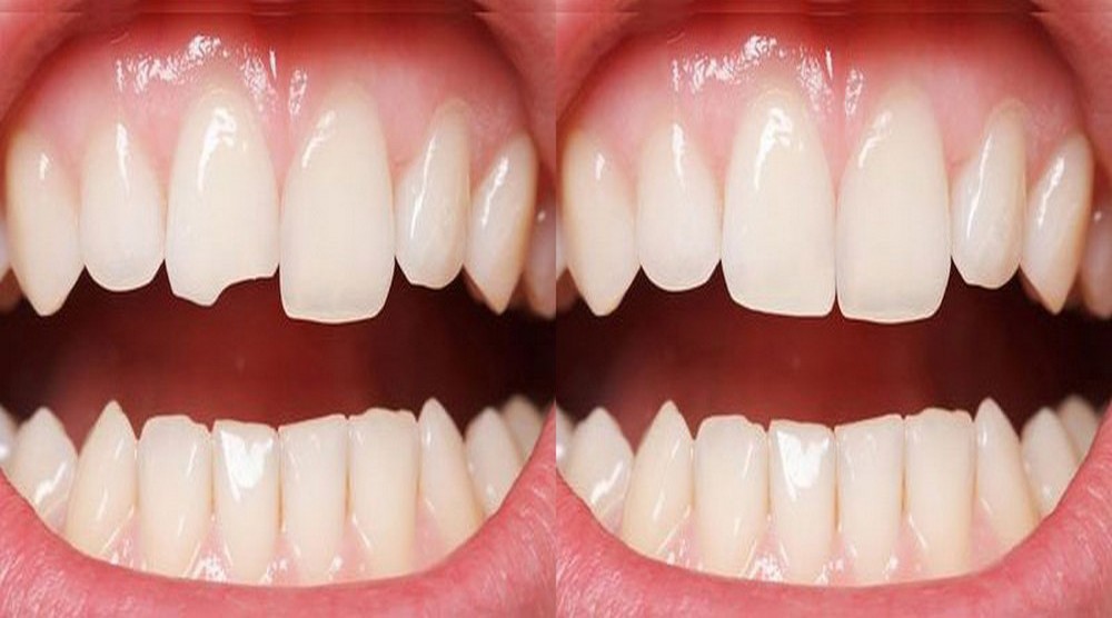 HAPPY BRACES