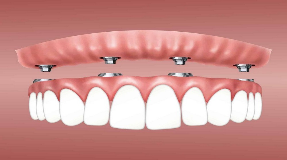 HAPPY BRACES