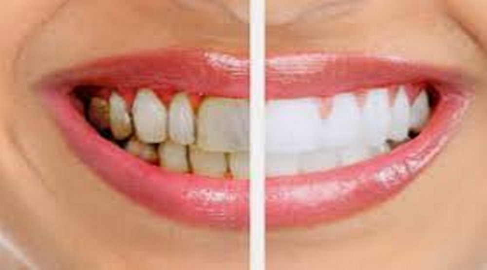 HAPPY BRACES