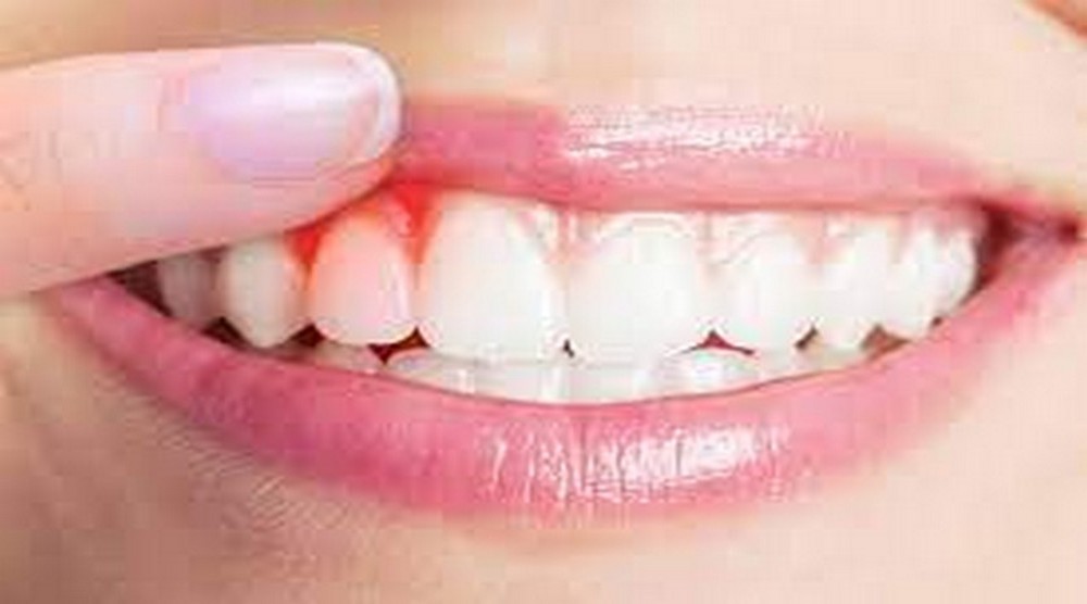 HAPPY BRACES