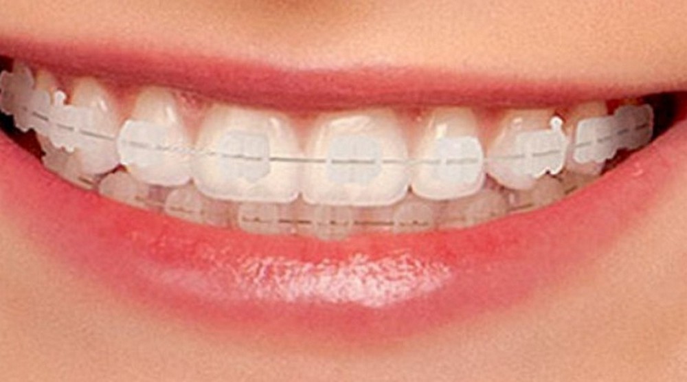 HAPPY BRACES