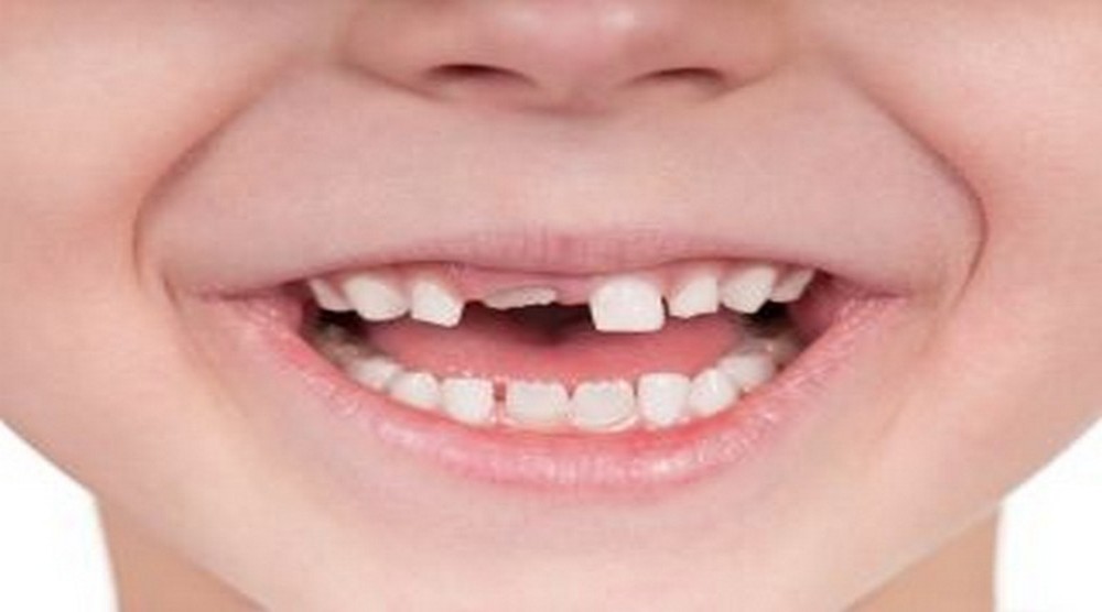 HAPPY BRACES